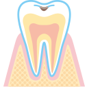 虫歯の進行C1
